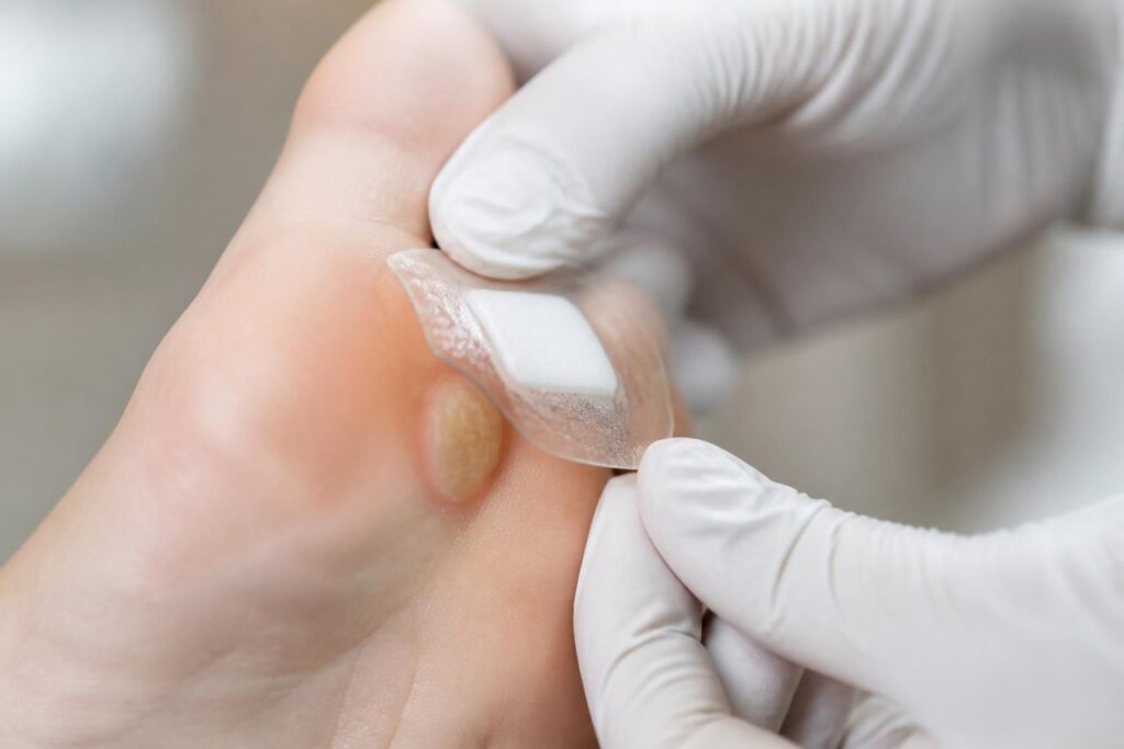 découvrez comment soigner et soulager rapidement une ampoule au pied, une cloque douloureuse souvent gênante, avec nos conseils pratiques et efficaces.